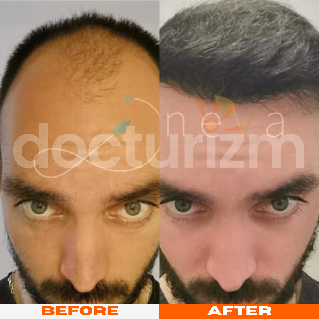 docturizm-capillaire-before